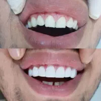 دندانپزشکی دندانسازی روکش