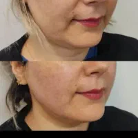 جشنواره درمان کک ومک/لک/خال/ریزش مودریک جلسه|خدمات آرایشگری و زیبایی|اصفهان, طامه|دیوار