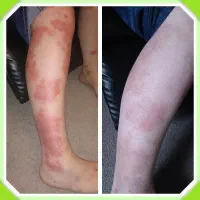 خودایمنی پسو|آرایشی، بهداشتی، درمانی|چالدران, |دیوار