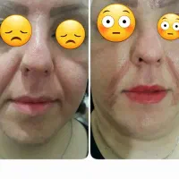 فیشیال (پاکسازی) خالبرداری و پلاسما صورت|خدمات آرایشگری و زیبایی|کوهدشت, |دیوار