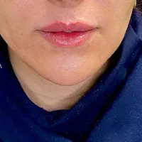 تزریق ژل وفیلر|خدمات آرایشگری و زیبایی|رباطکریم, رباطکریم|دیوار