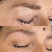 ریموو تک‌جلسه ای با رجووی اصل ومیکروبلیدینگ شیدینگ