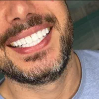 قسطی کامپوزیت کن عصب‌کشی از۳م باپرداخت شرایطی