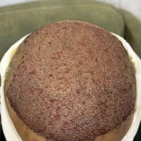 کاشت مو و ابرو