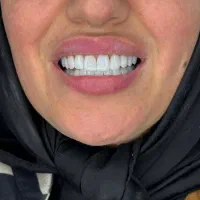 کامپوزیت با ۵ تومن
