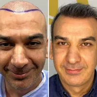 کاشت مو|خدمات آرایشگری و زیبایی|تهران, پاسداران|دیوار