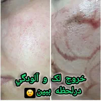درمان لک ها و مشکلات پوست با بروزترین متد|خدمات آرایشگری و زیبایی|مشهد, سرافرازان|دیوار