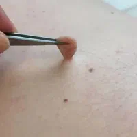 برداشت خال و منگولی های پوستی