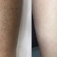 لیزر موهای زائد با الکساندرایت آمریکایی۲۰۲۵