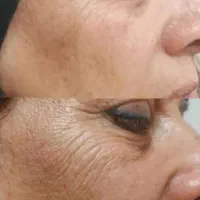 چین و چروکاتو از بین ببر تضمینی