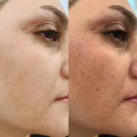 فیشال و پاکسازی صورت