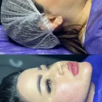 جراحی پلک غبغب صورت نخ آنزیم فیلر مزو ژل بوتاکس|خدمات آرایشگری و زیبایی|کرج, گوهردشت|دیوار