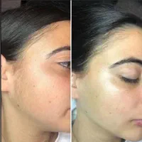 لیزر موهای زائد لیزرفول لیزر آقایان  لیزر بانوان|خدمات آرایشگری و زیبایی|اصفهان, باغ زرشک|دیوار