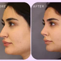 طراحیHipباسن فیلربادی ژل سینه بینی ابرو غبغب لاغری|خدمات زیبایی و سلامت|مشهد, هفت تیر (آب و برق)|دیوار
