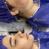 انواع جراحی های زیبایی بلفارو و ساکشن غبغب
