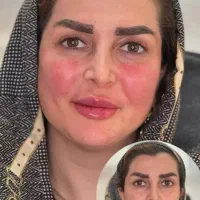 جشنواره زیبایی((ژل وبوتاکس))به مناسبت یلدا