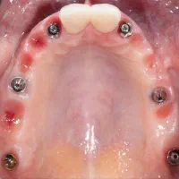 دندان پزشکی ایمپلنت روکش ارتودنسی اقساطی|خدمات آرایشگری و زیبایی|مراغه, |دیوار