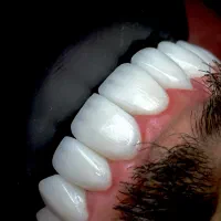 ایمپلنت کره ای با روکش ۱۲۹۰۰/دندانپزشکی|خدمات آرایشگری و زیبایی|تهران, تهرانپارس غربی|دیوار