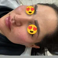 ژل و بوتاکس مزوتراپی و مزونیدلینگ آرایش دایم|خدمات آرایشگری و زیبایی|اردکان, |دیوار