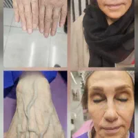 غبغب تزریق چربی لیفت بینی نانوفت صورت بلفارو