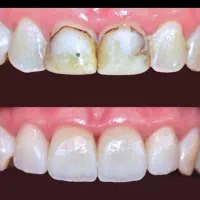 ترمیم و پر کردن دندان فقط ۱ میلیون و ۳۰۰|خدمات آرایشگری و زیبایی|ورامین, خیر آباد|دیوار