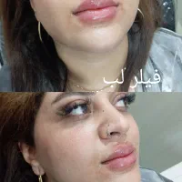 تزریق ژل بوتاکس نخ ...توسط پزشک در کلینیک سایماه|خدمات آرایشگری و زیبایی|کرمان, |دیوار