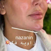 مطب گرگان عدالت ۱۳ بوتاکس ۸۰۰ ژل۱ تومان توسط پزشک|خدمات آرایشگری و زیبایی|گرگان, |دیوار