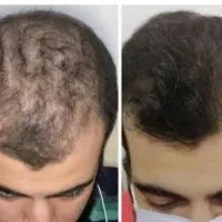 ارثی هم باشه در میاد
