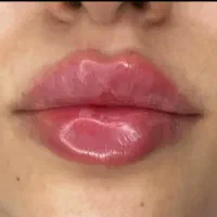 تزریق ژل فقط سیسی ۸۰۰بمدت سه روز|خدمات آرایشگری و زیبایی|زاهدان, |دیوار