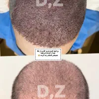 کاشت مو فول تراکم شیرازی در ساری|خدمات آرایشگری و زیبایی|ساری, |دیوار