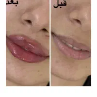 تزریق ژل بوتاکس|خدمات آرایشگری و زیبایی|شیراز, نصرآباد|دیوار