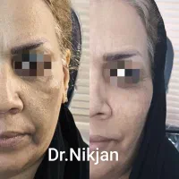 فیلر/بوتاکس/لیزر قسطی کلینیک زیبایی دکتر نیک جان