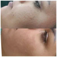 آموزش وخدمات فشیال پوست|خدمات آرایشگری و زیبایی|مبارکه, |دیوار