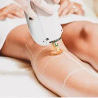 لیزر الکساندرایت گندم