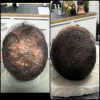 موهات ریزش مو داره همین الان اقدام کن