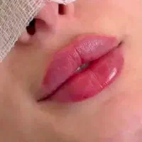 تزریق ژل لب/طبیعی جذابترشو/اصفهان
