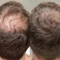 تخفیف پی ار پی prp درمان ریزش مو هفتصد هزار تومان