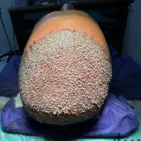 کاشت مو به روش نوین میکروfit و sut