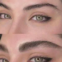 میکروبلیدینگ فیبروز