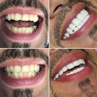 دندانپزشکی کامپوزیت لمینت ایمپلنت لیفت لثه بلچینگ|خدمات آرایشگری و زیبایی|مشهد, سجاد شهر|دیوار