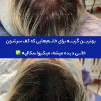 رفع کمپشتی مو با تکنیک میکرو اسکالپ /مکمل کاشتمو|خدمات آرایشگری و زیبایی|مشهد, احمدآباد|دیوار