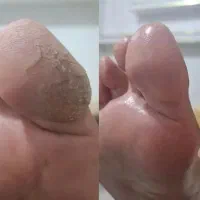 درمان پا (اسپا)