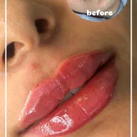 خدمات تخصصی ژل بوتاکس لیزر در کلینیک پزشکی|خدمات آرایشگری و زیبایی|شیراز, ارم|دیوار