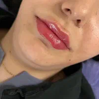 ژل و بوتاکس در مطب زیبایی