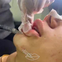 انجام خدمات تزریق فیلر و بوتاکس۵۰درصد تخفیف