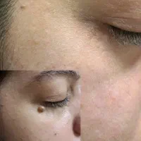 لیزر خال ( برداشتن خال) و پاکسازی صورت (بانوان )