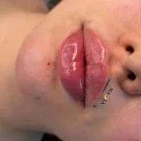 تزریق ژل و بوتاکس تضمینی|خدمات آرایشگری و زیبایی|قرچک, مهدیه|دیوار