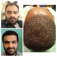 کاشت مو ‌ابرو خدمات زیبایی رینو پلاستی لیپو ابدو