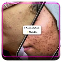 پاکسازی پوست درمان جوش جای جوش لک و کک ومک|خدمات آرایشگری و زیبایی|اصفهان, ملک‌شهر|دیوار