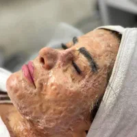 تخفیف تابستونه فشیال پوست